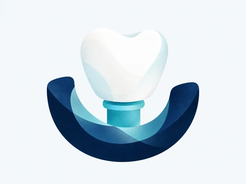 Implantes dentários