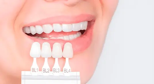 Facetas de porcelana