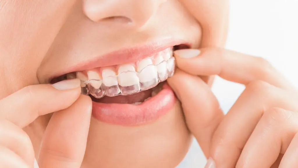Alinhadores invisíveis Invisalign